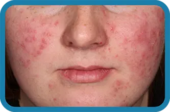 Image of young woman before starting treatment with Seysara