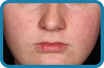 Image of young woman after 3 weeks of treatment with Seysara