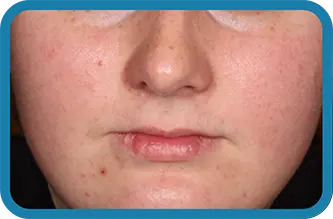 Image of young woman after 12 weeks of treatment with Seysara