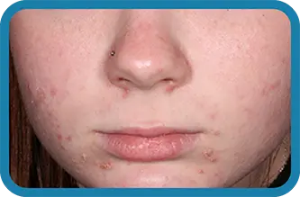 A young woman before starting treatment with Seysara
