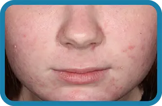 A young woman after 3 weeks of treatment with Seysara

