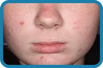 A young woman after 12 weeks of treatment with Seysara
