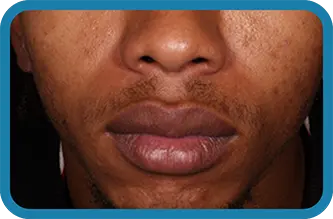 A young man before starting treatment with Seysara
