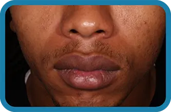 A young man after 3 weeks of treatment with Seysara
