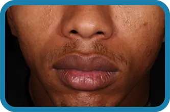 A young man after 12 weeks of treatment with Seysara

