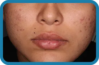A young woman before starting treatment with Seysara
