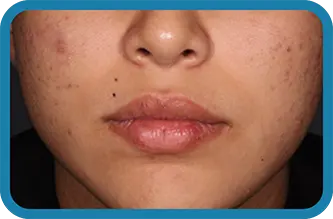 A young woman after 3 weeks of treatment with Seysara
