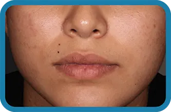 A young woman after 12 weeks of treatment with Seysara

