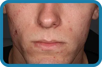 A young man before starting treatment with Seysara