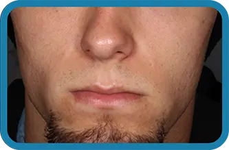 A young man after 12 weeks of treatment with Seysara