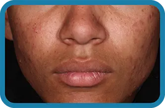 A young man before starting treatment with Seysara
