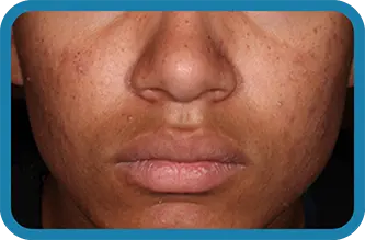 A young man after 3 weeks of treatment with Seysara
