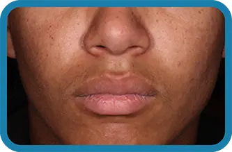 A young man after 12 weeks of treatment with Seysara
